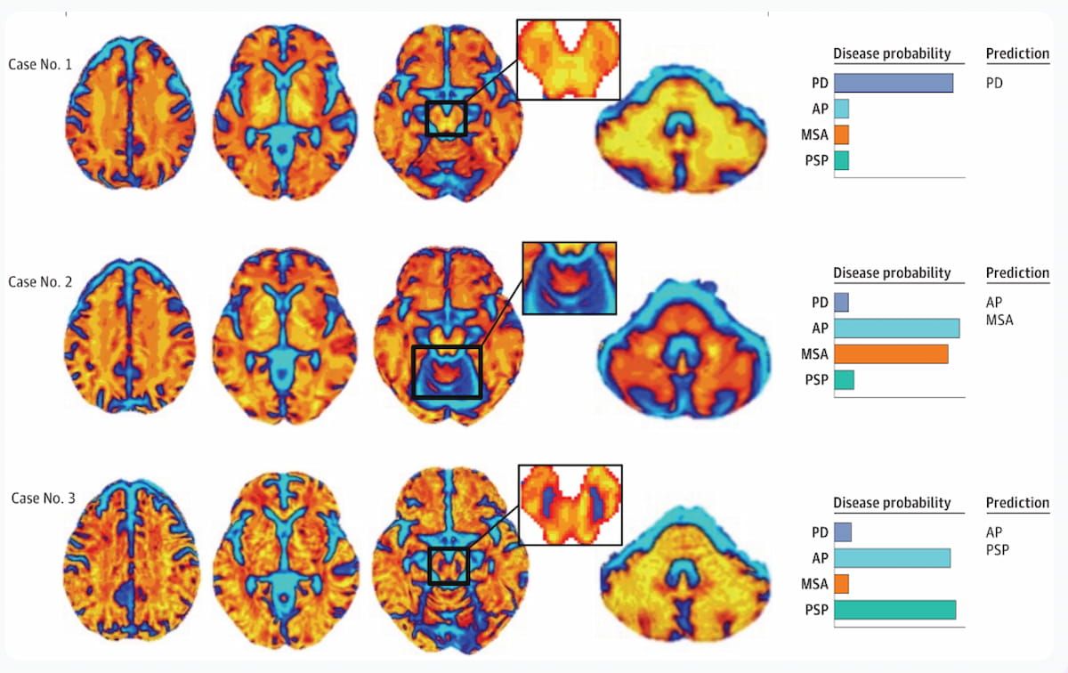 Diffusion MRI Software for Parkinsonian Syndromes Gets FDA De Novo Classification