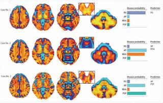Diffusion MRI Software for Parkinsonian Syndromes Gets FDA De Novo Classification