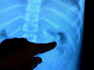 Aluminum can stay-tabs still pose swallowing risk for children