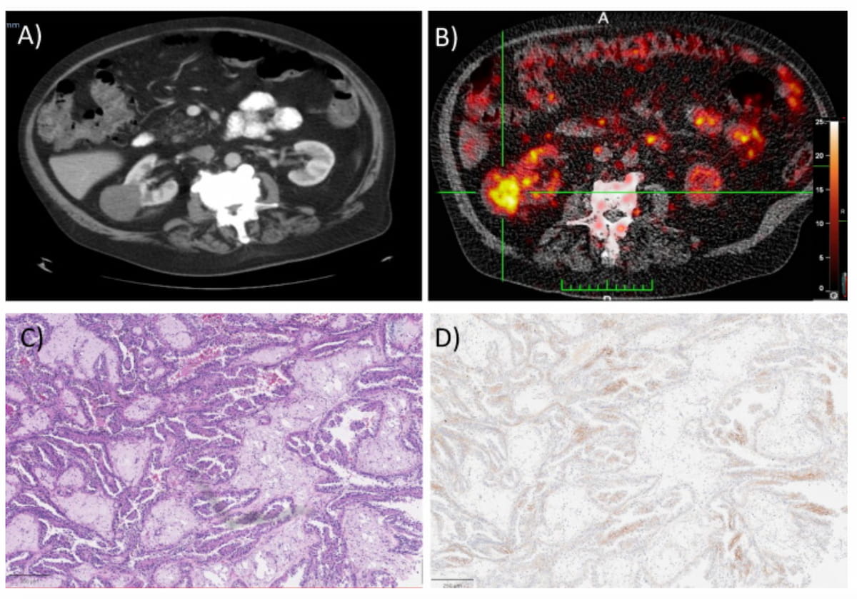Study Shows Impact of CAIX-Targeted PET Radiotracer for Renal Malignancies