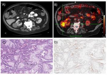 Study Shows Impact of CAIX-Targeted PET Radiotracer for Renal Malignancies 