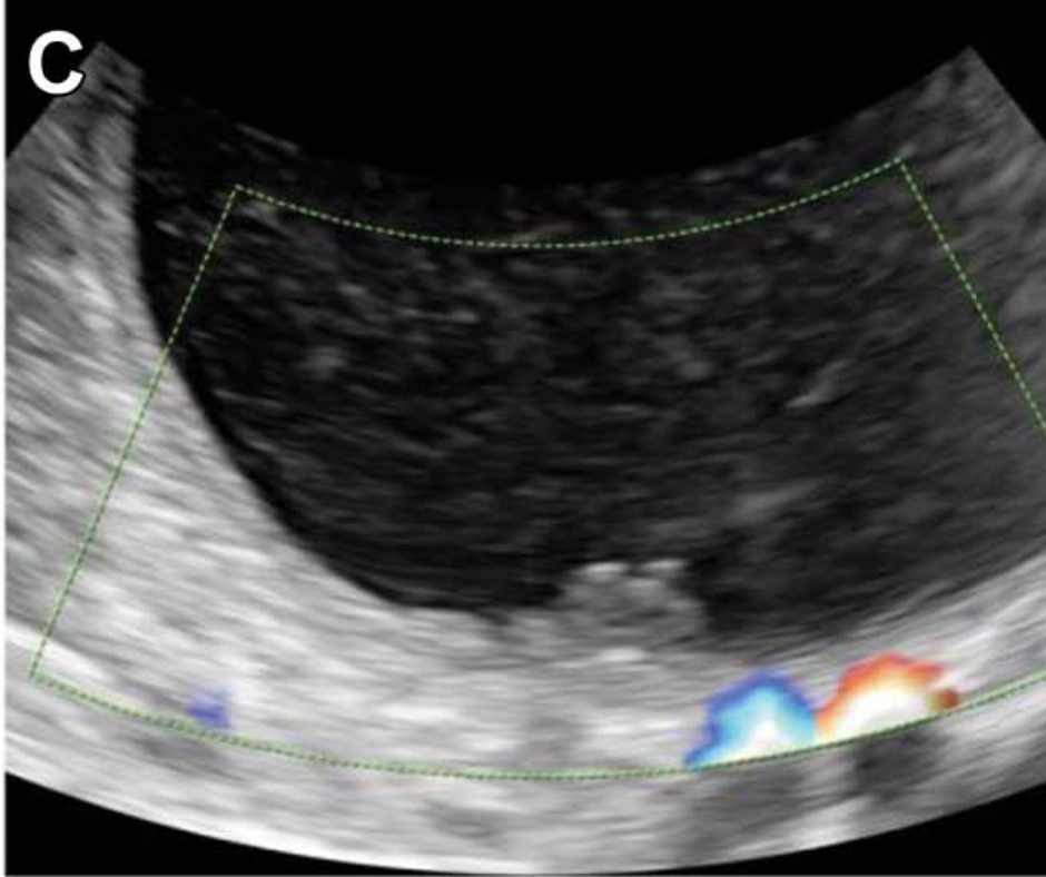 Can Deep Learning Ultrasound Assessment be a Viable Option for Diagnosing Ovarian Cancer?