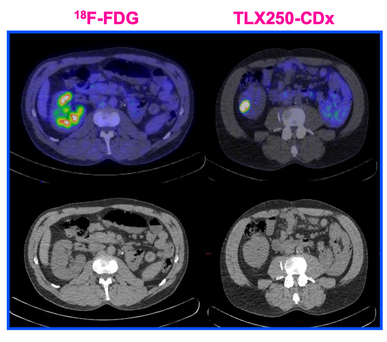 Emerging PET/CT Imaging Agent Shows Promise for Diagnosing Clear Cell ...