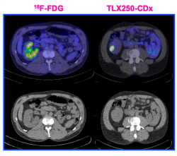 Emerging PET/CT Imaging Agent Shows Promise for Diagnosing Clear Cell Renal Cell Carcinoma