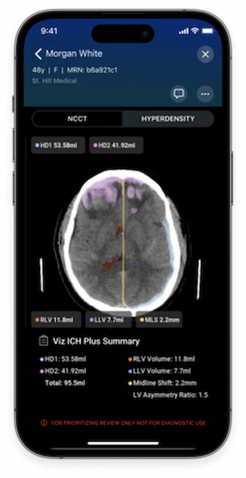FDA Clears AI Software for Assessing Intracerebral Hemorrhage on Non-Contrast CT