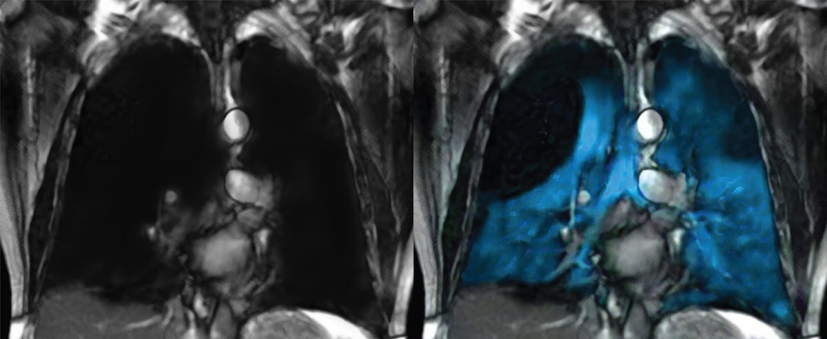 Collaboration Between Philips And Polarean Allows Routine MRI Access To collaboration-between-philips-and-polarean-allows-routine-mri-access-to