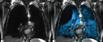 Collaboration Between Philips and Polarean Allows Routine MRI Access to High-Res Imaging of Lung Ventilation