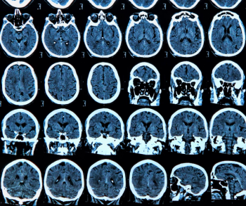 FDA Clears Brain MRI-Based Software for Assessing Cortical Disarray Measurement