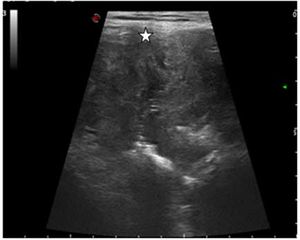 Malignant Supravesical  Mass in Urachal Remnant