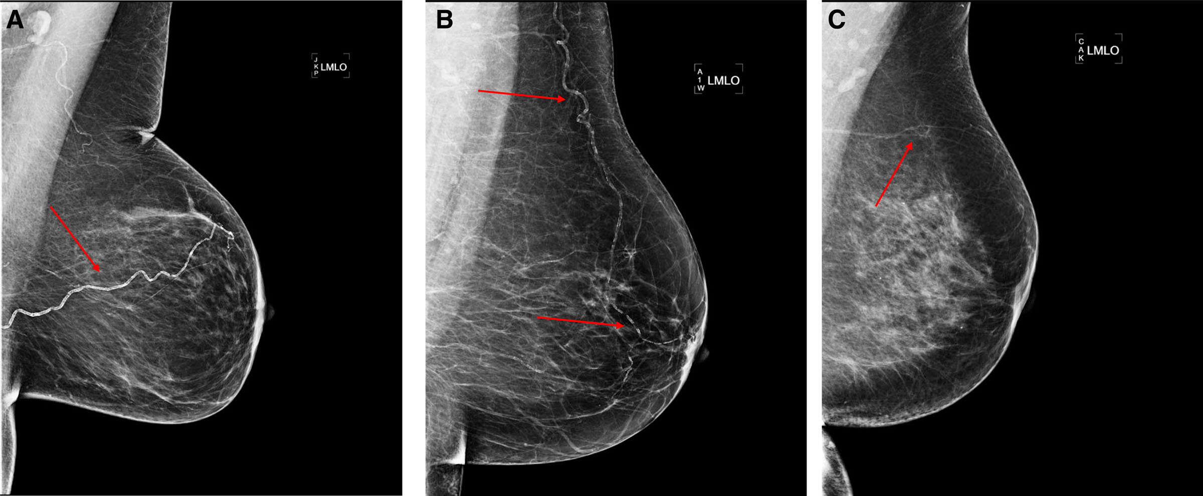 Study Shows Link Between Breast Arterial Calcification And Significant
