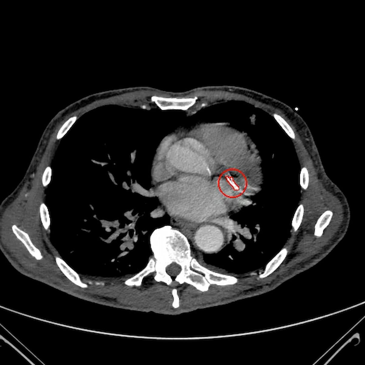 FDA Clears CT-Based AI Software for Evaluating Coronary Artery and Aortic Valve Calcium