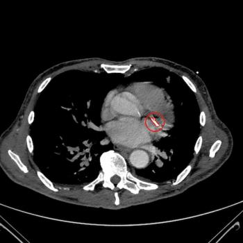 FDA Clears CT-Based AI Software for Evaluating Coronary Artery and Aortic Valve Calcium