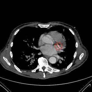 FDA Clears CT-Based AI Software for Evaluating Coronary Artery and Aortic Valve Calcium