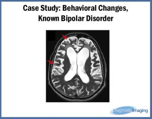 Behavioral Changes, Known Bipolar Disorder