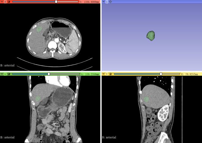 Ct Radiomics Nomogram Shows Promise In Predicting Early Recurrence Of Hepatocellular Carcinoma 6028