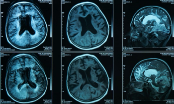 FDA Clears AI-Powered MRI Software to Assess for Brain Atrophy