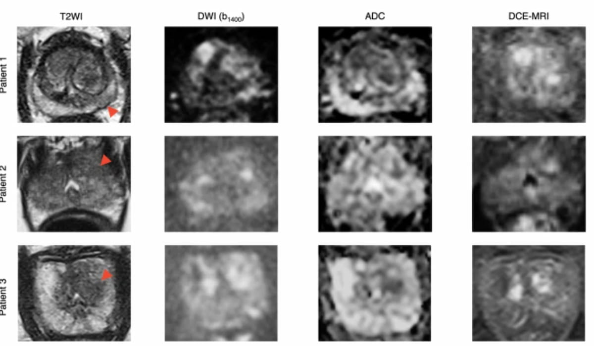 Can AI Bolster Prostate Biopsy Efficiency?: What a Multicenter MRI Study Reveals