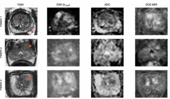 Can AI Bolster Prostate Biopsy Efficiency?: What a Multicenter MRI Study Reveals