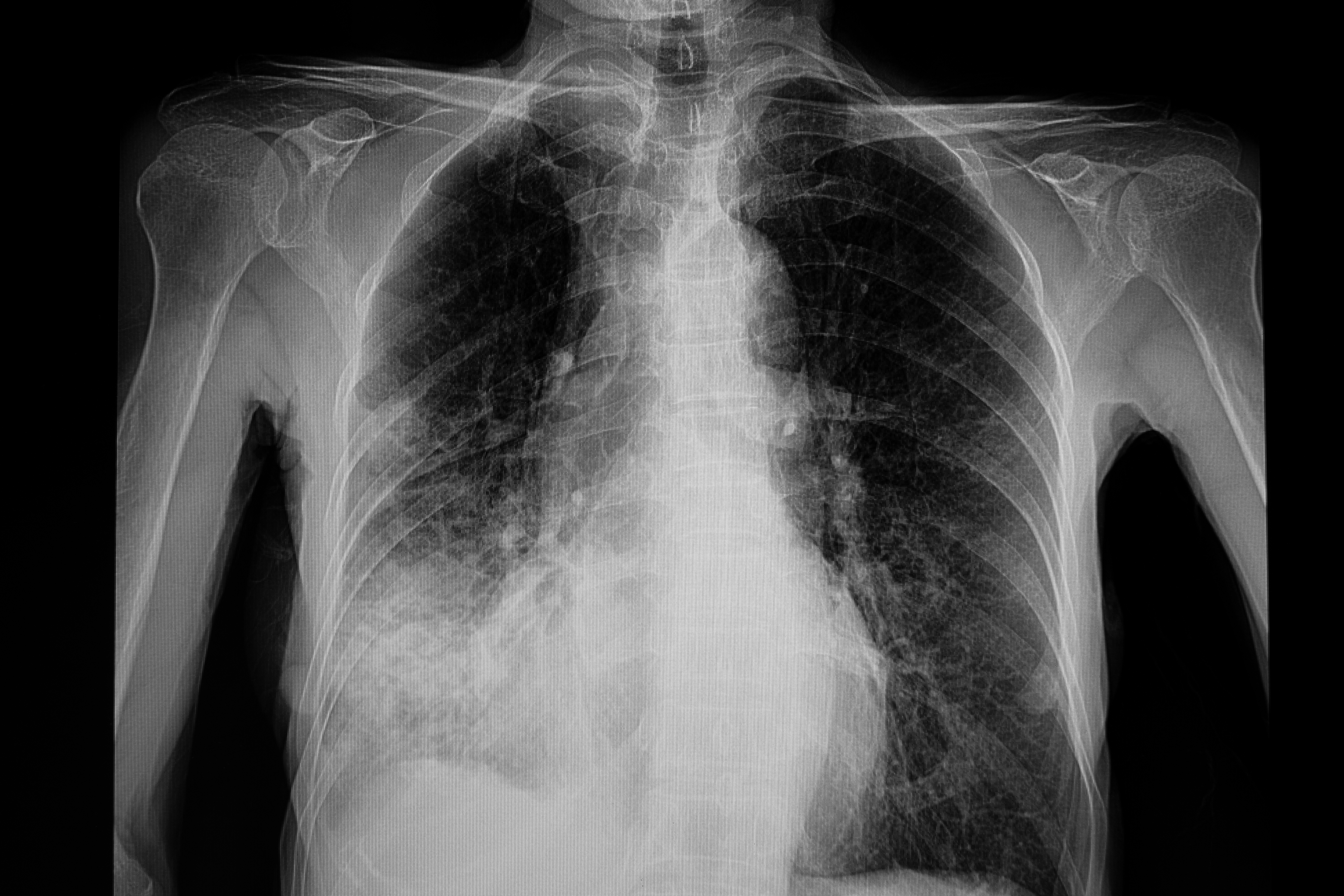 Правая пневмония. Covid pneumonia XRAY. Pneumonia Chest x ray.