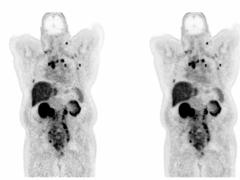 FDA Clears Next-Generation AI-Powered PET Imaging Software
