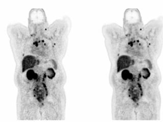 FDA Clears Next-Generation AI-Powered PET Imaging Software