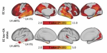 New PET Study Links Higher Education Level to Speed of Tau Accumulation with Alzheimer’s Disease