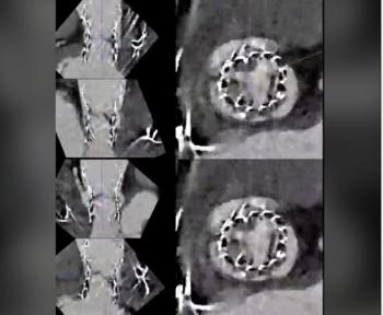 Could Photon-Counting CT Supplant Echocardiography for Primary Imaging of Transcatheter Heart Valves?