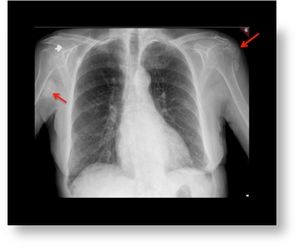 Image IQ: 74 y/o; Lump over right axillary region