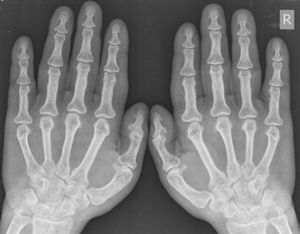 Pituitary Adenoma Causing Acromegaly