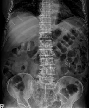 Pneumatosis Intestinalis