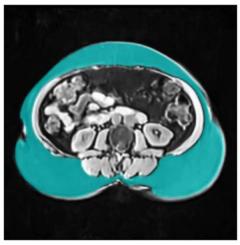 FDA Clears MRI-Based AI Software for Body Composition Analysis