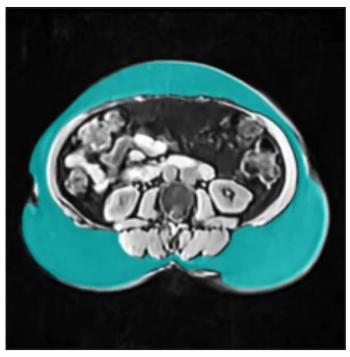 FDA Clears MRI-Based AI Software for Body Composition Analysis