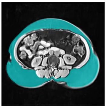 FDA Clears MRI-Based AI Software for Body Composition Analysis