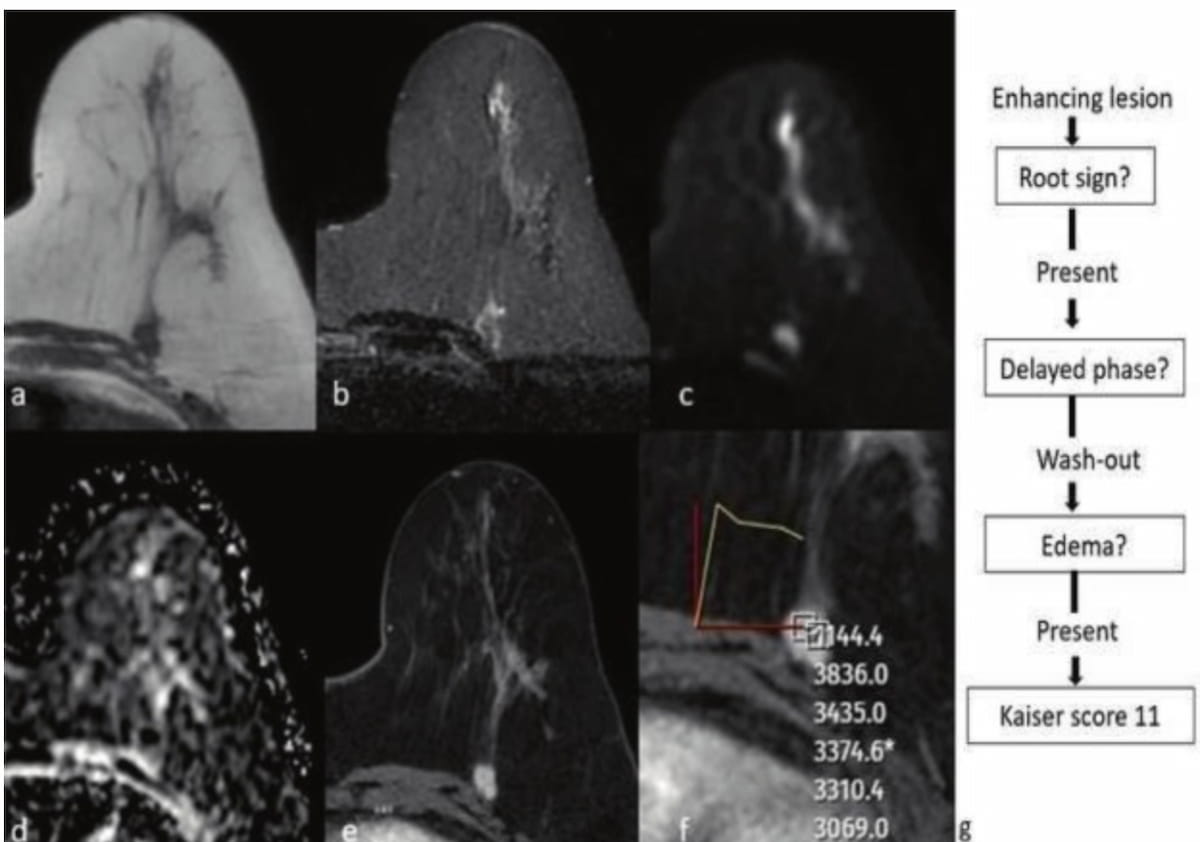 Can the Kaiser Score with Breast MRI Improve Clarity for BI-RADS 0 and 4 Assessments on Mammography and Ultrasound?