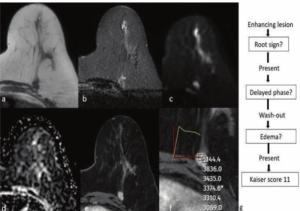 Can the Kaiser Score with Breast MRI Improve Clarity for BI-RADS 0 and 4 Assessments on Mammography and Ultrasound?