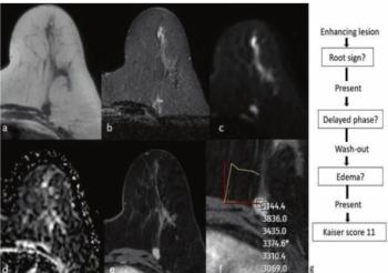 Can the Kaiser Score with Breast MRI Improve Clarity for BI-RADS 0 and 4 Assessments on Mammography and Ultrasound?