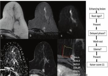 Can the Kaiser Score with Breast MRI Improve Clarity for BI-RADS 0 and 4 Assessments on Mammography and Ultrasound?