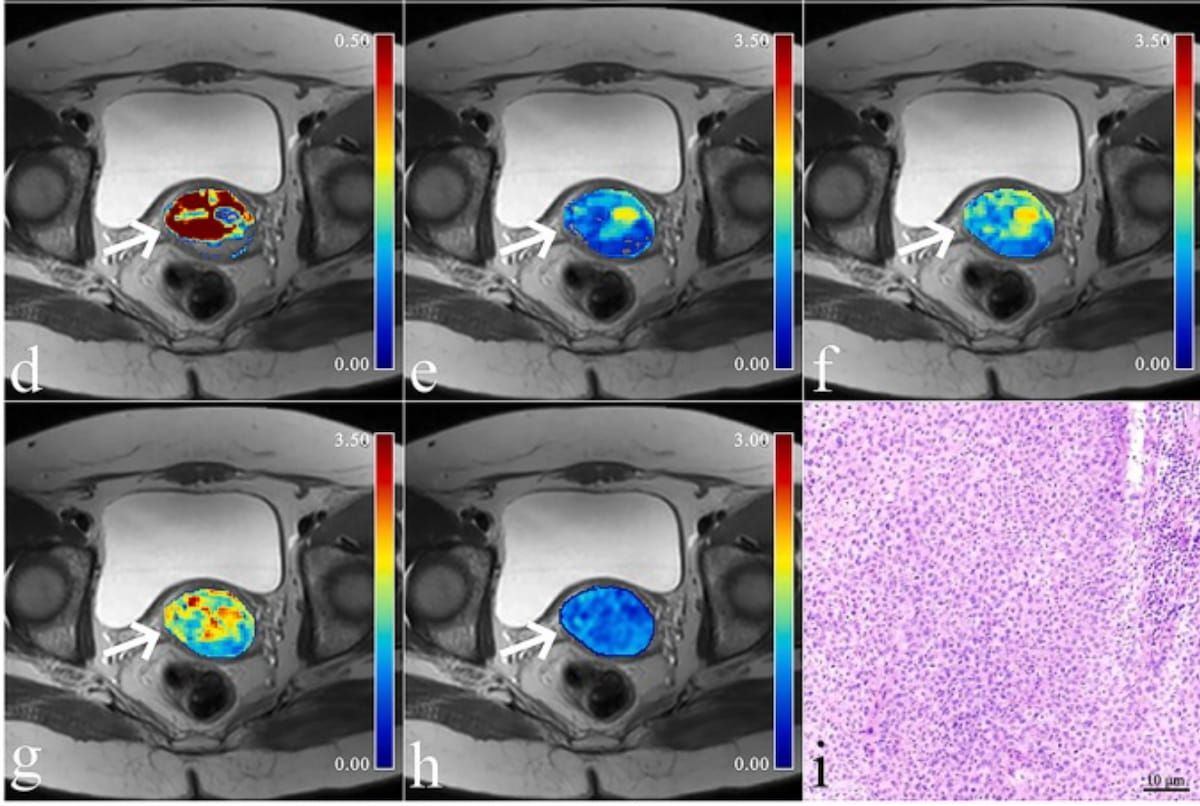 Could a Novel MRI Combination Marker Bolster Pre-Op Assessment of Cervical Cancer?