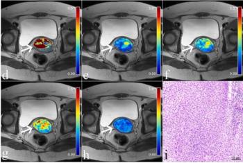 Could a Novel MRI Combination Marker Bolster Pre-Op Assessment of Cervical Cancer?