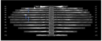 Can CT Bone Reading Software Enhance Detection of Metastatic Rib Lesions in Women with Breast Cancer?