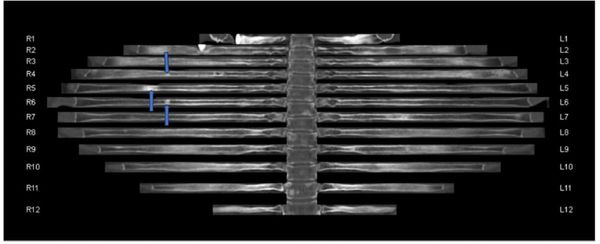 Can CT Bone Reading Software Enhance Detection of Metastatic Rib Lesions in Women with Breast Cancer?