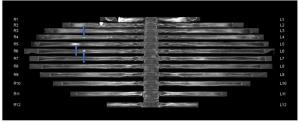 Can CT Bone Reading Software Enhance Detection of Metastatic Rib Lesions in Women with Breast Cancer?