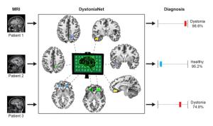 AI Identifies Focal Dystonia Almost Instantaneously on MRI