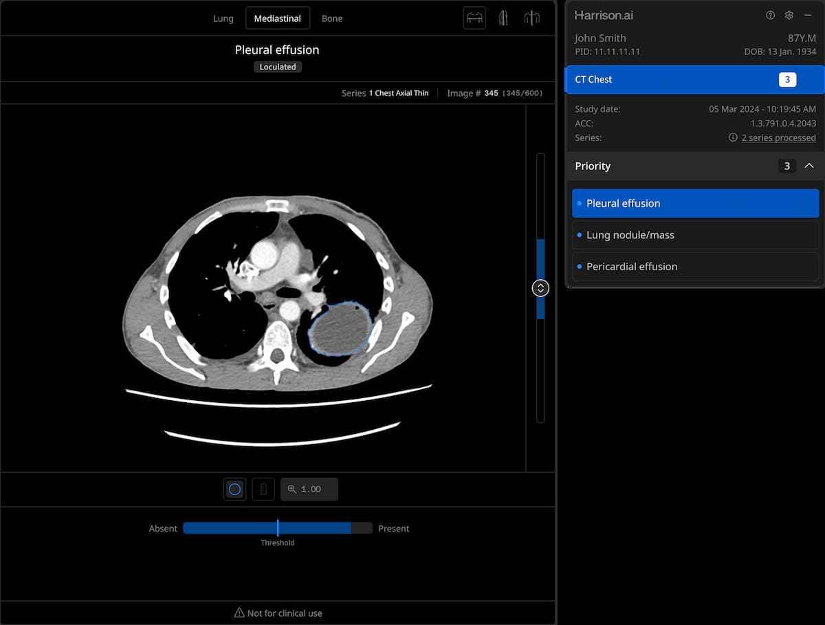 Harrison.ai Launches AI-Powered CT Chest Software