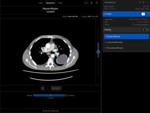 Harrison.ai Launches AI-Powered CT Chest Software