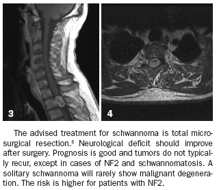 Intradural Extramedullary Schwannoma