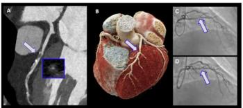 Can Photon-Counting CT Enhance the Detection of Obstructive CAD?