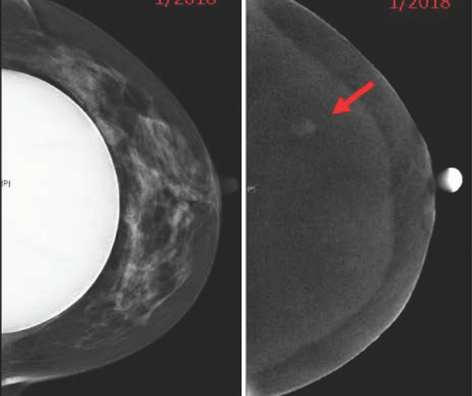 Study Highlights Use Of Contrast-Enhanced Mammography In Women With ...