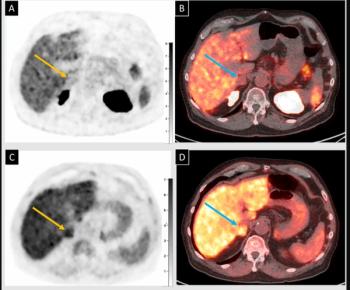 SNMMI: Can 18F-Fluciclovine PET/CT Bolster Detection of PCa Recurrence in the Prostate Bed?