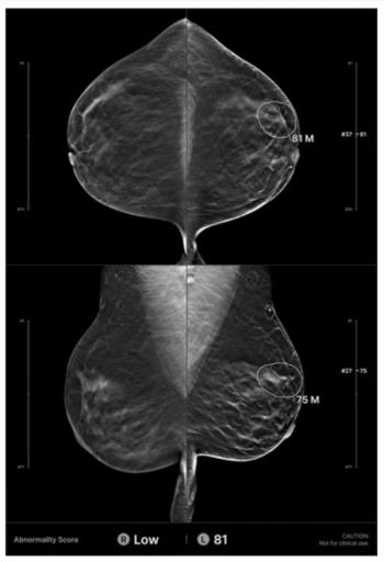 Reducing the Interval Breast Cancer Rate of Screening DBT: Can AI Have an Impact?